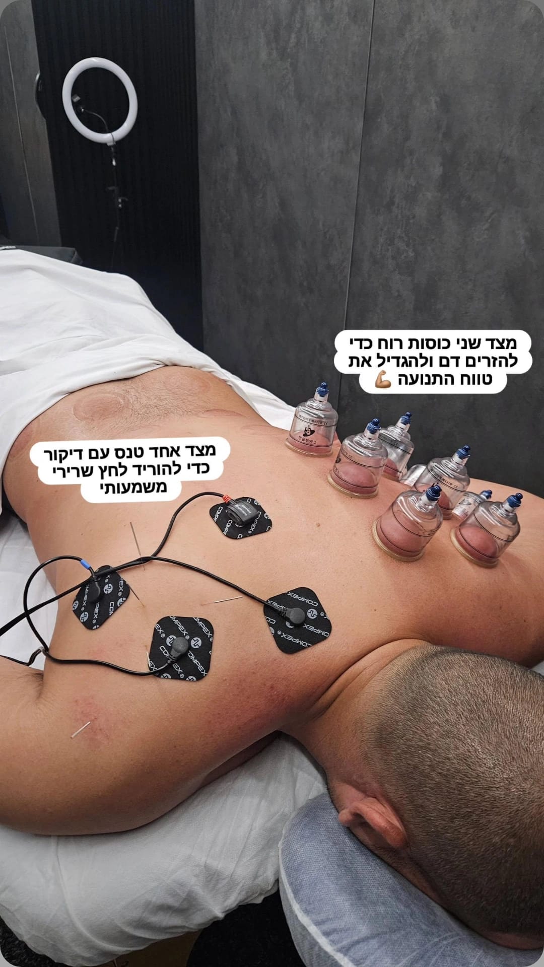 שילוב כוסות רוח, דיקור וגירוי חשמלי